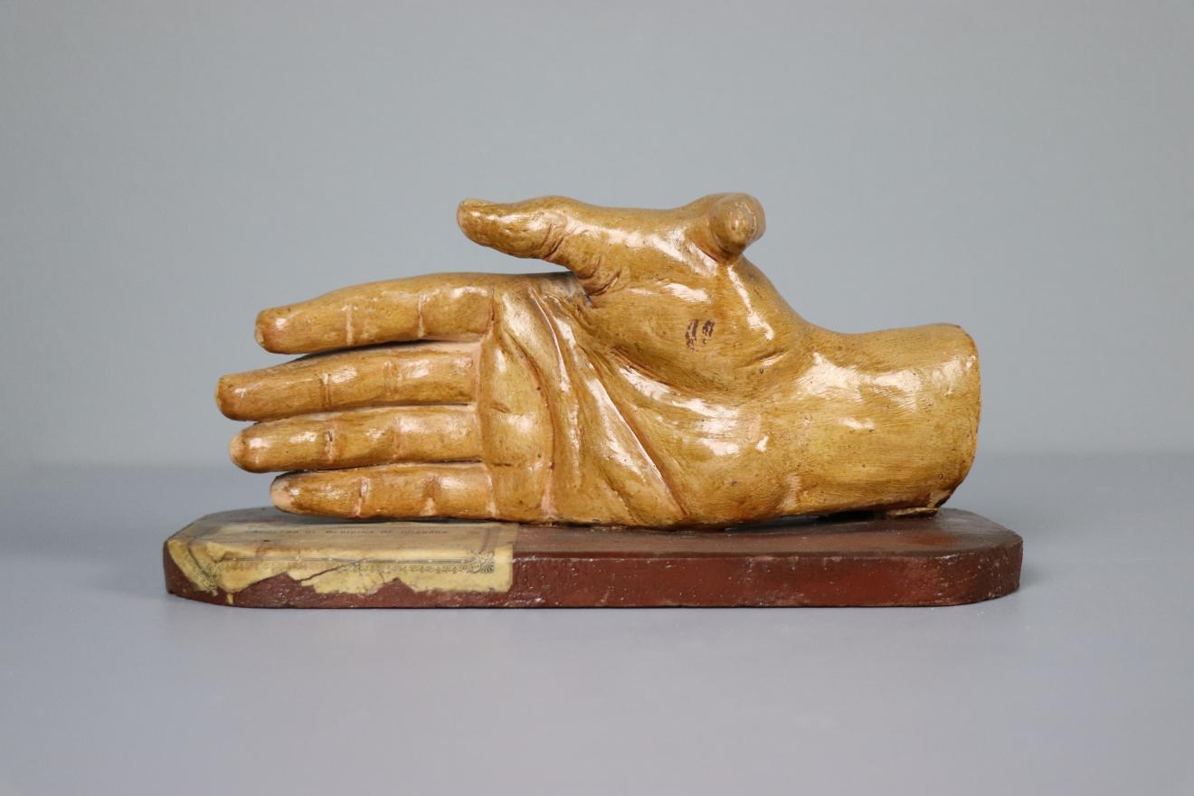 Mano con dedo supernumerario adosado al 1º dedo