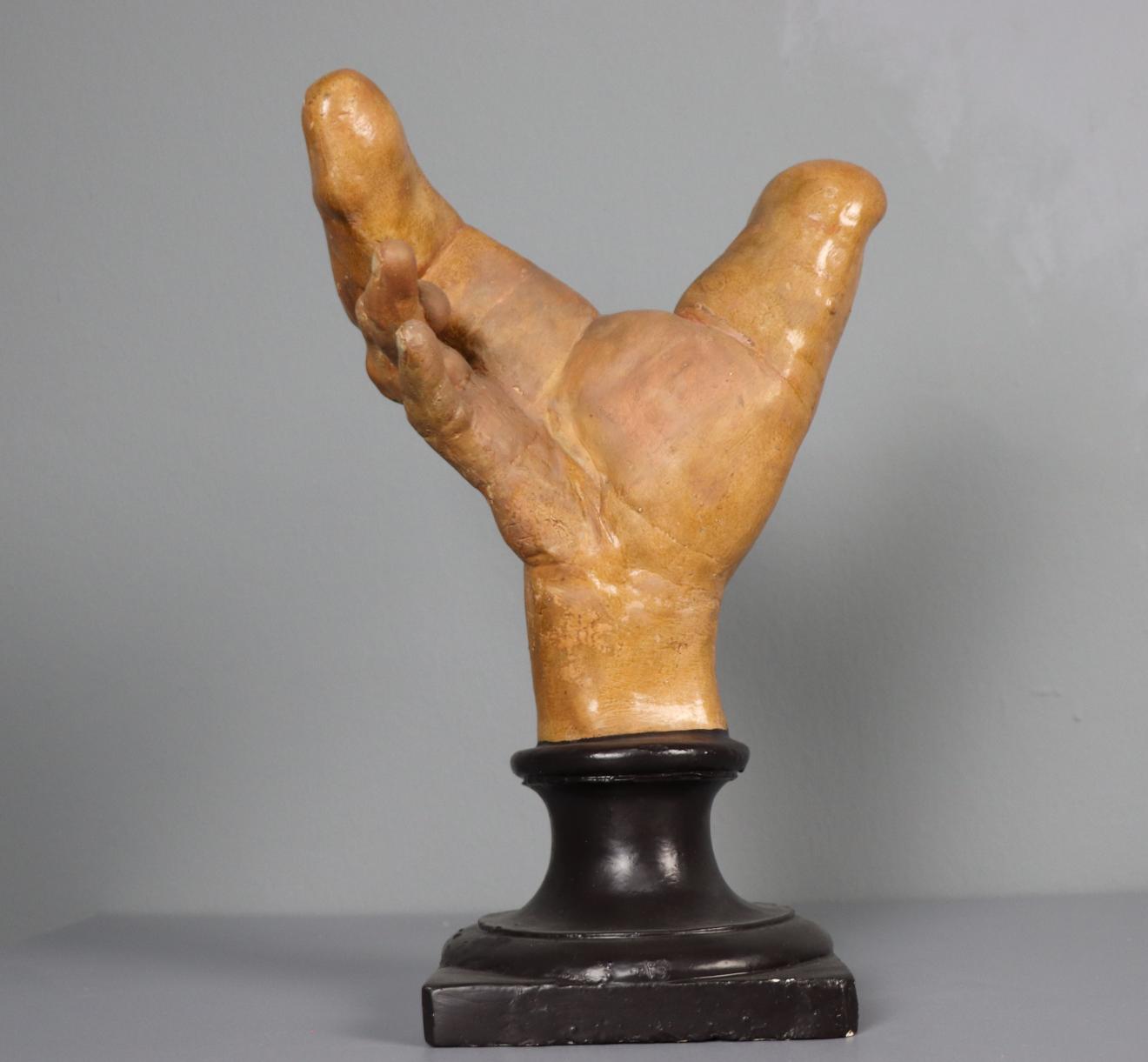 Megalodactilia de la mano