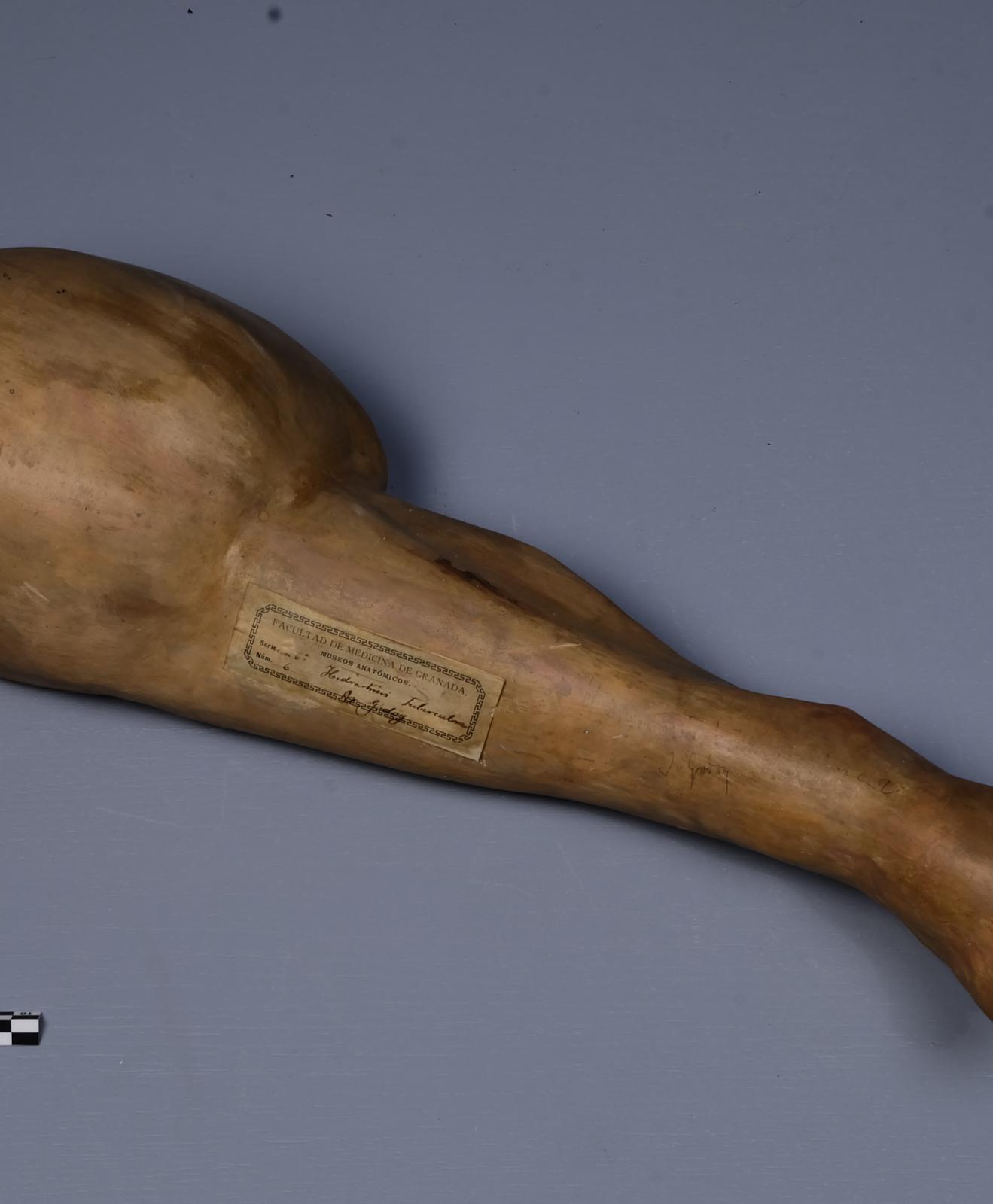 Hidrartritis tuberculosa