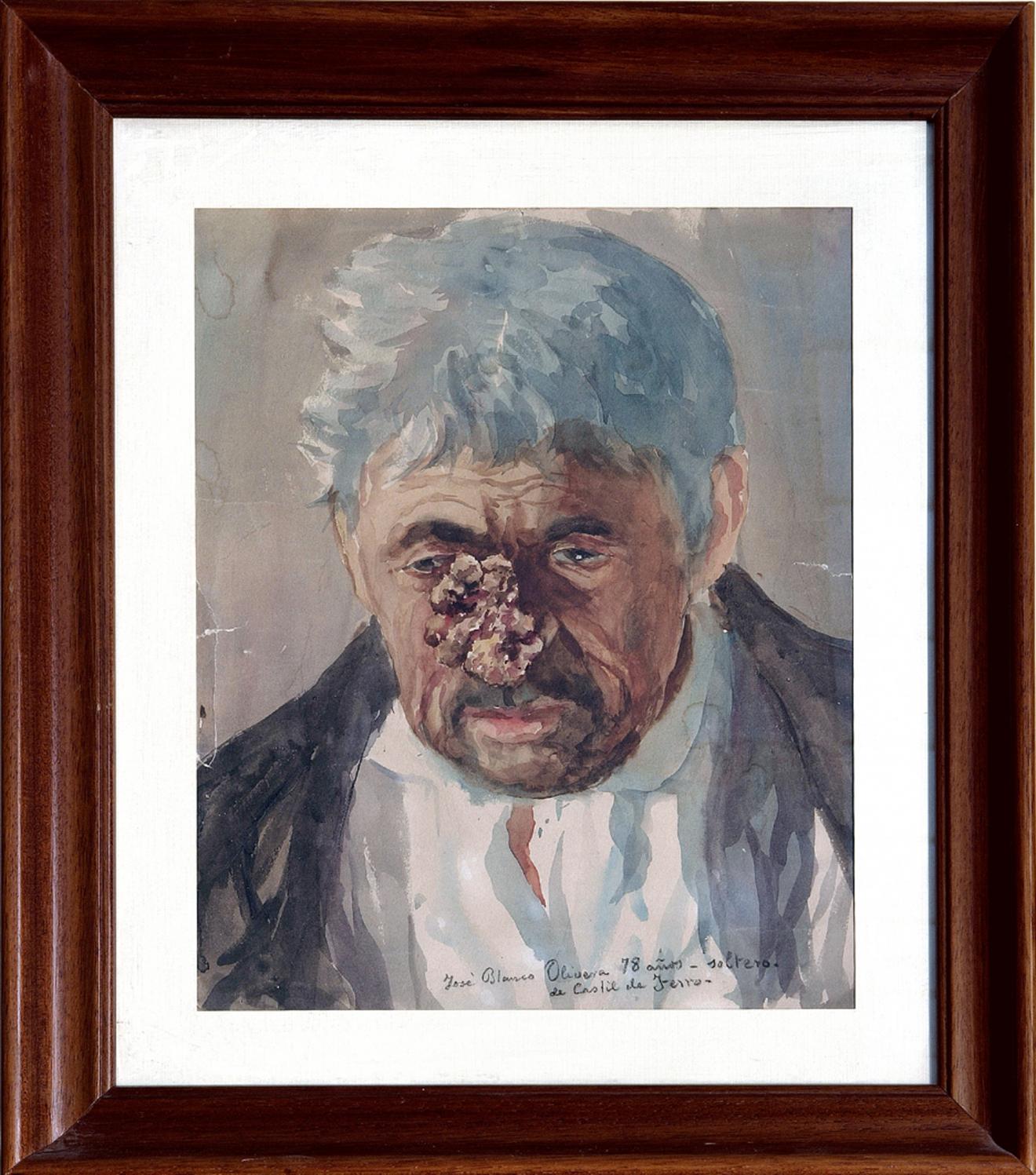 Retrato de José Blanco Olivera. (Pintura anatómica)