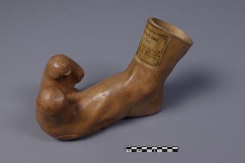 Megalodactilia del 1º y sindactilia del 2º y 3º